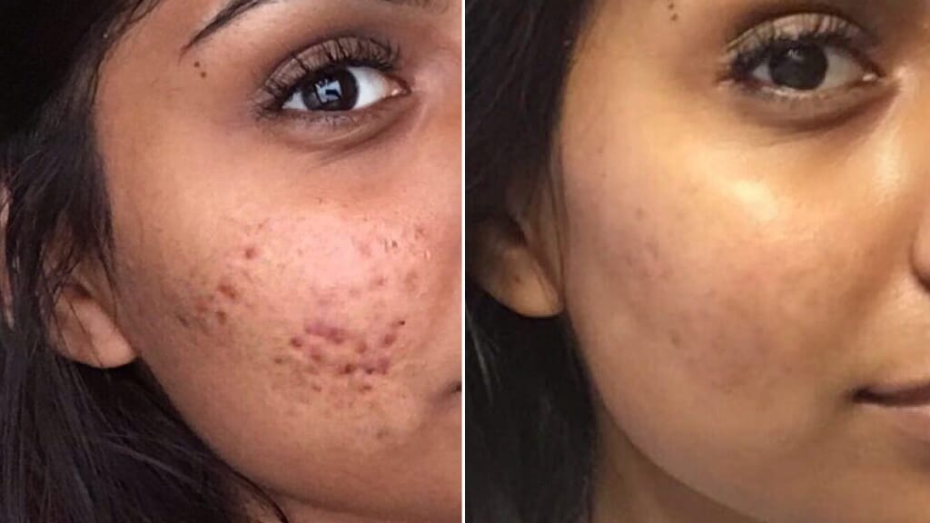 Green Coffee Beans Help Acne